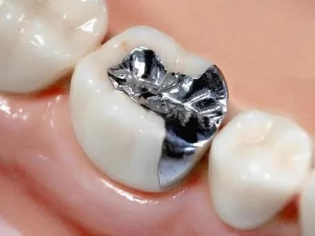 【悲報】銀歯が臭すぎるｗｗｗｗｗｗｗｗｗｗｗｗｗｗｗｗ