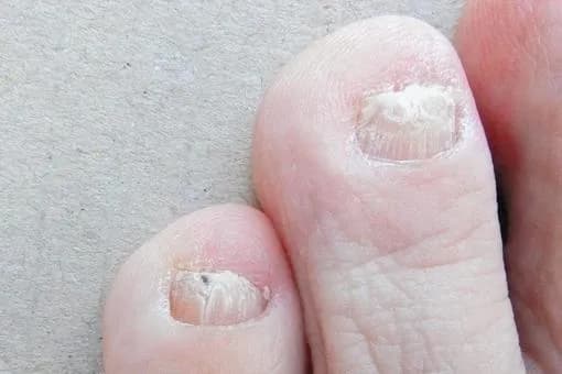 【悲報】爪水虫、罹ったら終わりｗｗｗｗｗｗｗｗｗｗｗｗｗｗｗｗ