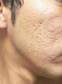 【急募】クレーターになったニキビ跡←これの治し方教えてくれｗｗｗｗｗｗｗｗｗｗｗｗｗｗｗｗ