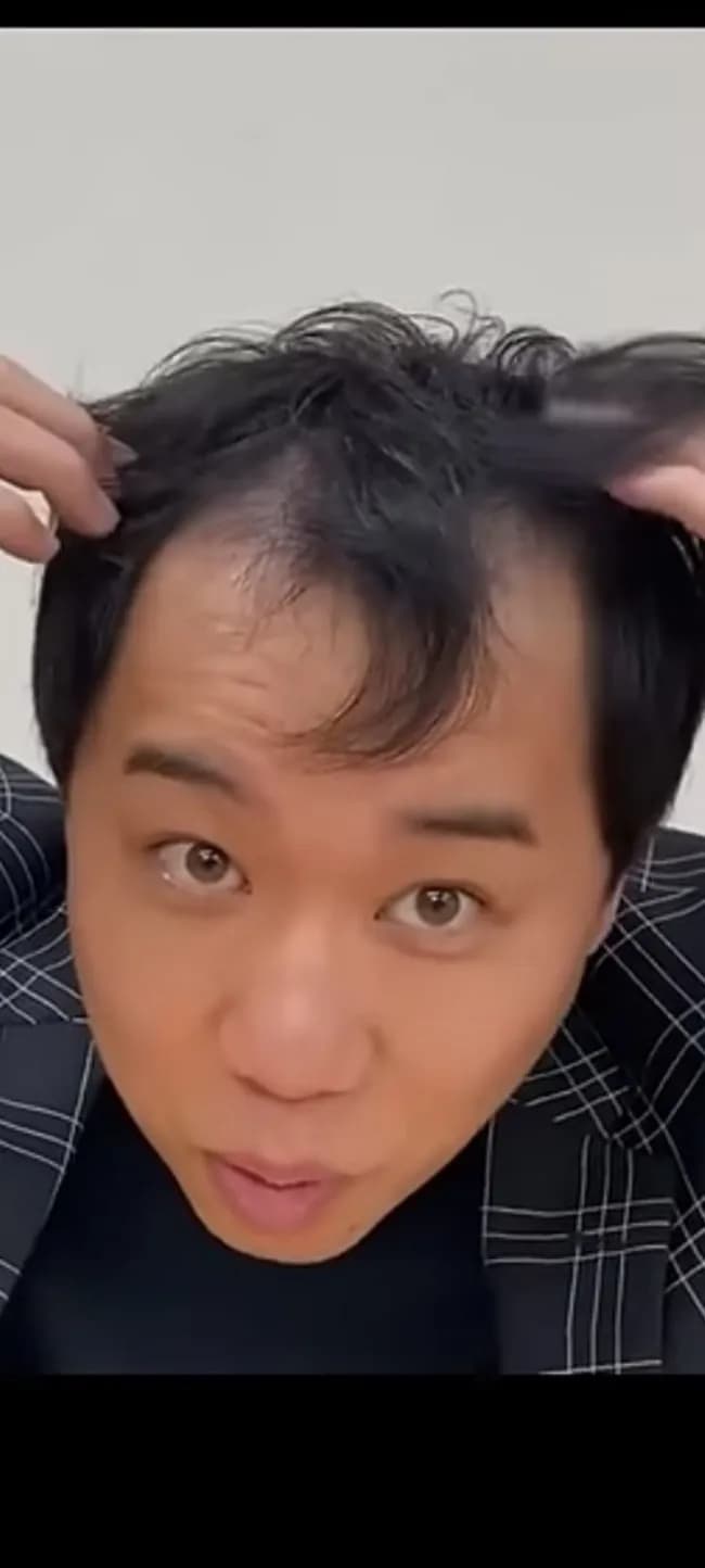 【画像】霜降り明星のせいやさん、ガチでハゲていた…