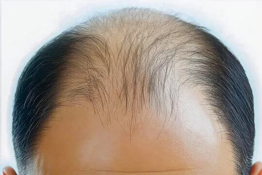 【速報】「ハゲ」、来月から放送禁止用語へ →代替表現は「ナチュラル」で統一・・・・