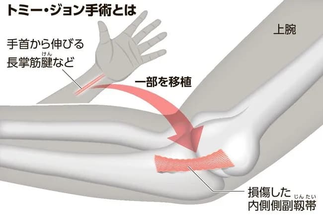トミー・ジョン手術「靭帯の代わりに腱を移植します」←これズルじゃね？？
