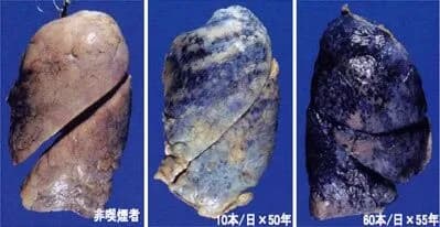 【画像】タバコを吸った肺、真っ黒すぎてやばい。（おまえらの想像以上にやばい）