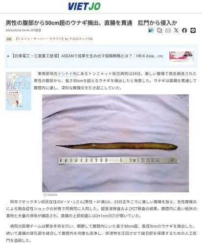 【衝撃】マンさん「お腹痛いよ、タスケテ」→お腹から50cmのウナギが見つかり緊急入院ｗｗｗｗｗｗｗｗｗｗ