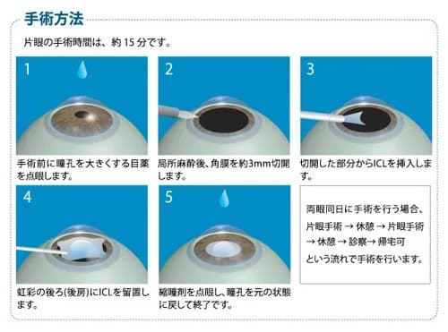 【悲報】ICL眼内コンタクトレンズやったやつおる？ガチで悩んでるんやが・・・・・・・・・