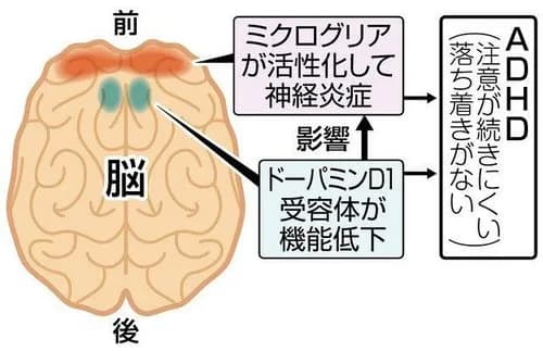 【悲報】「ASD」「ADHD」「不安障害」「双極性障害」←この中に1つだけガチで救いがない障害が混じってるwwwwwwwwww