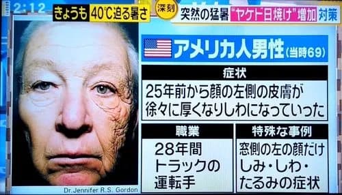 【悲報】男さん、日焼け止めを塗らなかった結果wwwwwwwwww
